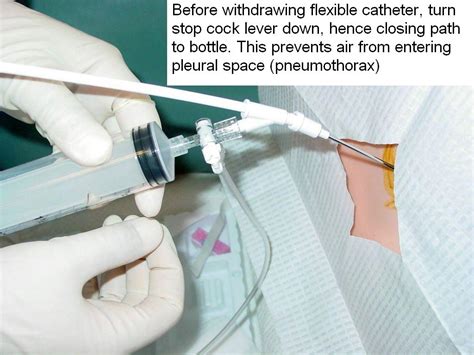 Clinical Notes Thoracentesis A Step By Step Procedure Guide With Photos