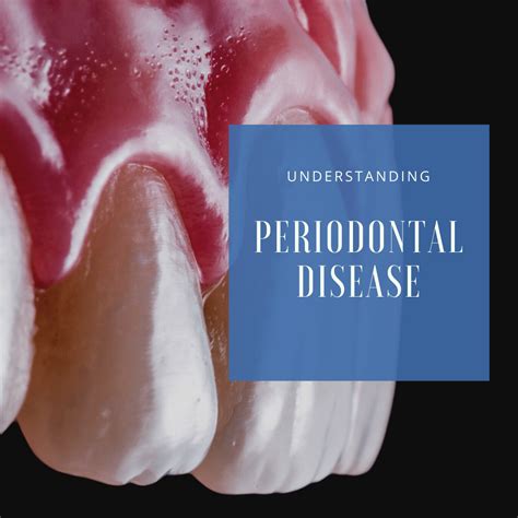 Understanding Periodontal Disease Chicago Dental Implants