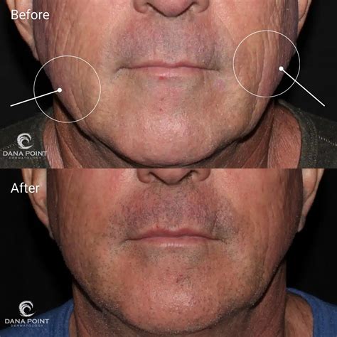 Ablative Fractionated Co2 Laser Resurfacing Men Before And After Dana Point Dermatology