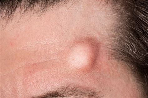 Skin Cyst Removal In Singapore By Doctor Robert Ong 2025