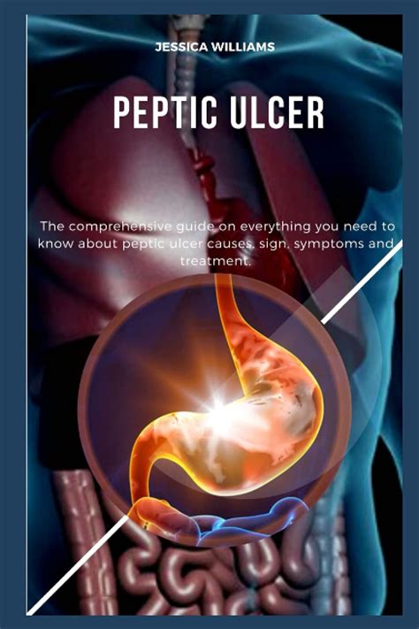 Buy PEPTIC ULCER: The comprehensive guide on everything you need to ...