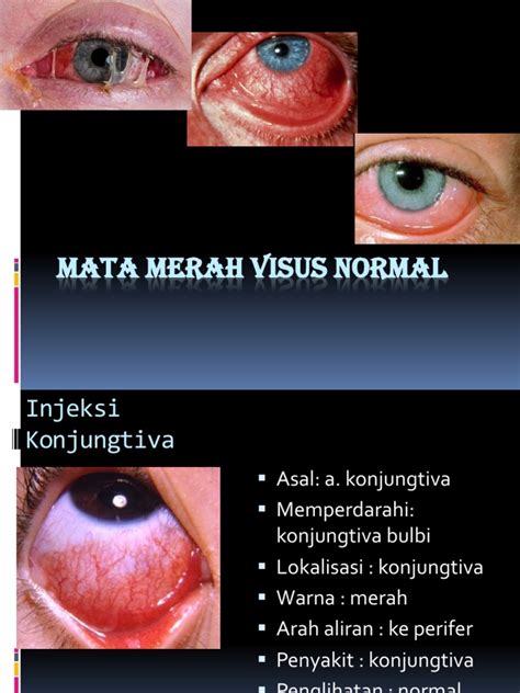 Mata Merah Visus Normal Pdf