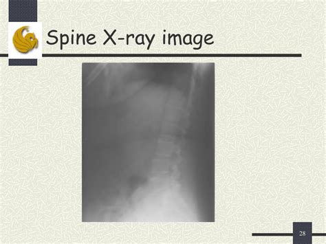 Ppt Computer Aided Diagnosis System For Lumbar Spinal Stenosis Using X Ray Images Powerpoint