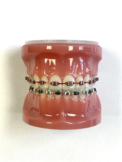 Braces Treatment - Hub City Orthodontics
