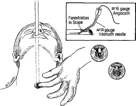 Tracheoesophageal Puncture