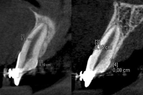 Measurement Of The Labial And Palatal Alveolar Bone Heights On