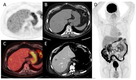 PET Imaging in Bladder Cancer: An Update and Future Direction