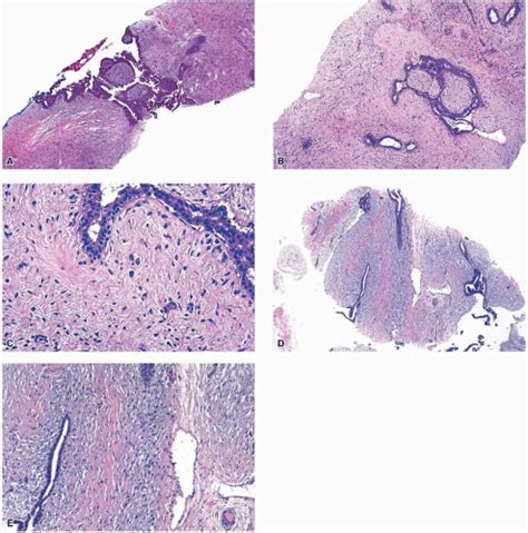 Fibroepithelial Neoplasms Basicmedical Key