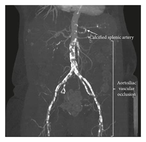 A Ct Reconstruction Showing Aortoiliac Vascular Occlusion And Calcified