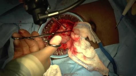 Minilaparotomy Minimally Invasive Approach To Abdominal Myomectomy