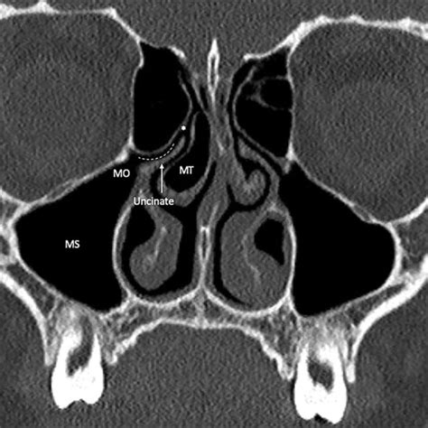 Stage 3 Maxillary Sinus Atelectasis In A 12 Year Old Girl With Chronic