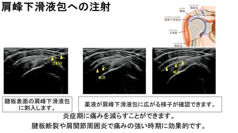 超音波ガイド下注射 上田整形外科内科