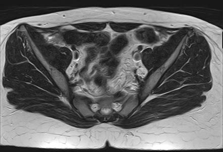 Mayer Rokitansky K Ster Hauser Syndrome Mrkh Image Radiopaedia Org