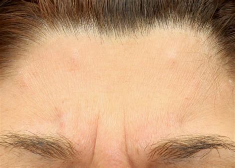 Botox Glabella - Lloyd Dermatology Center