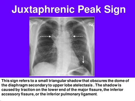 Radiological signs in chest medicine part 2