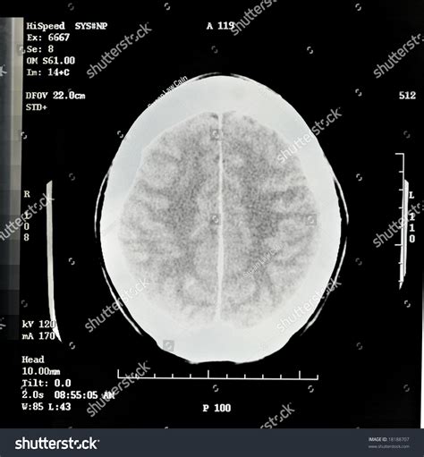 Brain Cat Scan Stock Photo 18188707 - Shutterstock