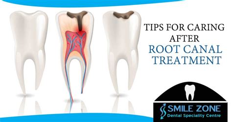 Tips For Caring After Root Canal Treatment