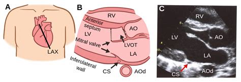 Echo Parasternal Long Axis View