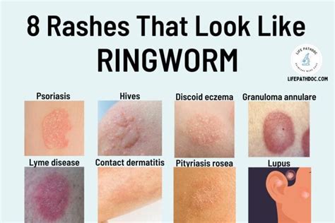 8 Rashes That Look Like Ringworm But Aren't (With Pictures)