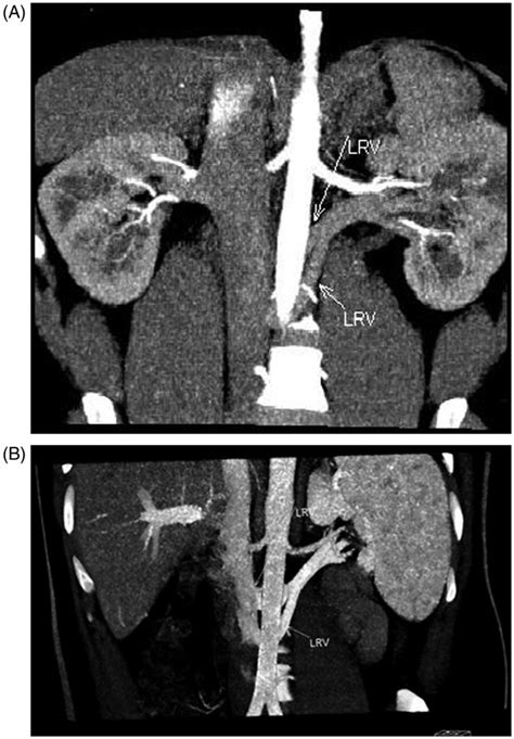 Mdct Angiogram In 25 Year Old Male Renal Donor With Two Retroaortic