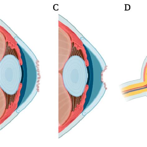 Pathogenesis and adverse events of microbial keratitis. (A) Corneal... | Download Scientific Diagram