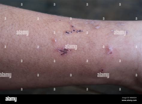 Diabetic Foot Infection Fotos Und Bildmaterial In Hoher Auflösung Alamy