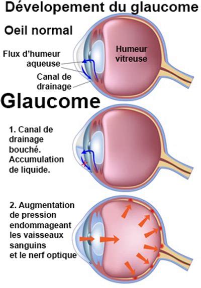 PDF Anatomie du glaucome Glaucome à angle ouvert Les Adolescents PDF