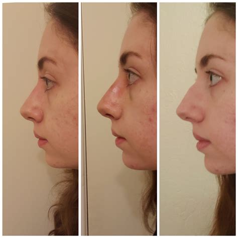 Septorhinoplasty Swelling Progression Weeks Post Op Vs Cast Off