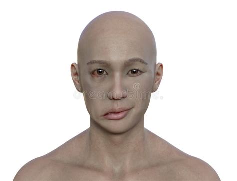 Facial Palsy In A Man 3d Illustration Highlighting The Asymmetry And Drooping Of The Facial