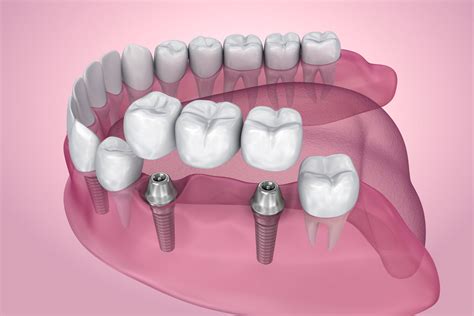 ¿Qué es un Puente Dental Fijo? | Clínica Maydental