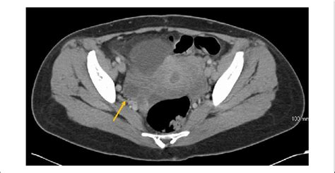 Computed Tomography Scan Of Abdomen And Pelvis Revealed A Cystic