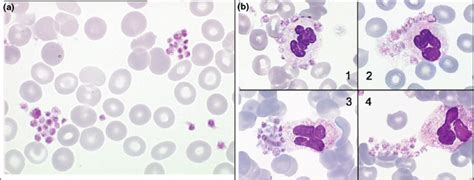 Spurious Counts And Spurious Results On Haematology Analysers A Review