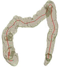 A Colon After Segmentation Process B The Colon After The