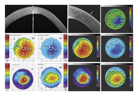 Cornea With Keratoconus The Decrease In Corneal Epithelial Thickness