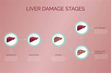 1,100+ Hepatic Carcinoma Stock Photos, Pictures & Royalty-Free Images ...