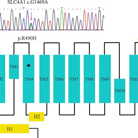 Sanger Sequencing Of The Pathogenic Sptb Cc4873t Mutation In Proband D