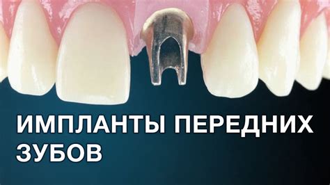Имплантация передних зубов. Особенности протезирования. - YouTube