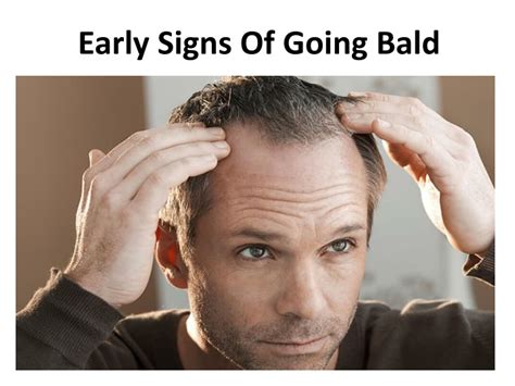 Baldness Myths And Misconceptions Justinboey