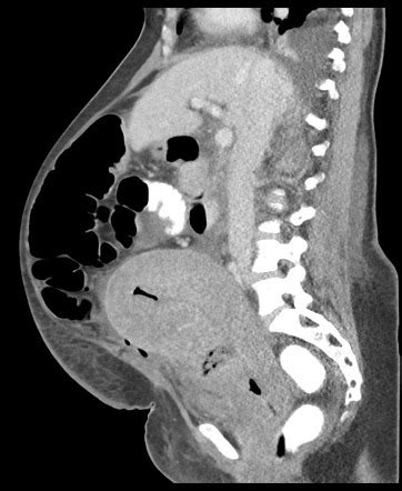 Uterine dehiscence | Radiology Reference Article | Radiopaedia.org