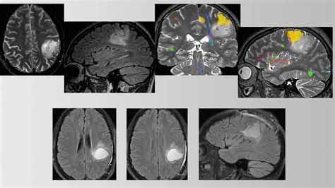 Sensorimotor Mapping For Glioma The Neurosurgical Atlas