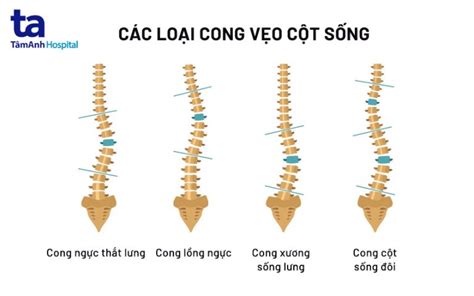 Cong Vẹo Cột Sống Nguyên Nhân Triệu Chứng Chẩn đoán Phòng Ngừa