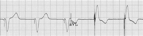 Ventricular Paced Rhythm