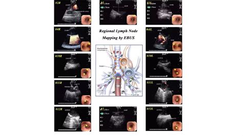 Endobronchial Ultrasound Ebus Ppt