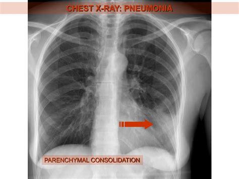 PPT - CHEST X-RAY: PLEURAL EFFUSION PowerPoint Presentation, free download - ID:4816322