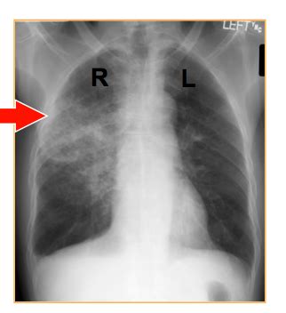 Lower Respiratory Tract Infections Test 4 Flashcards Quizlet