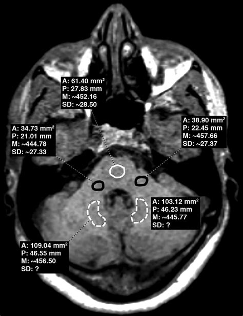 Evaluation Of Gadolinium Deposition In The Brain After Mr Arthrography