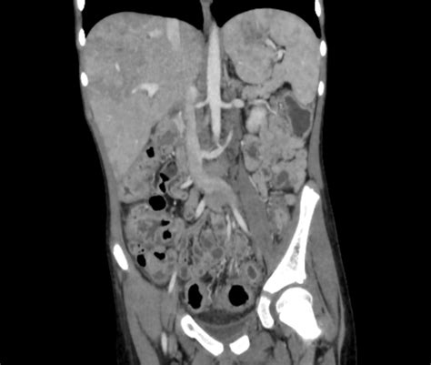 Ulcerative Colitis With Thromboembolism Image Radiopaedia Org