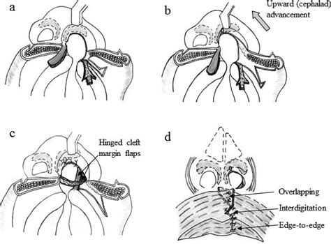 Schematic Demonstration Of Correction Of Primary Unilateral Cleft Lip