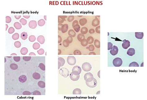 Peripheral smear – RBC – Histopathology.guru