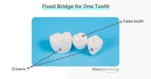 Removable Dental Bridge: Pros & Cons - Share Dental Care